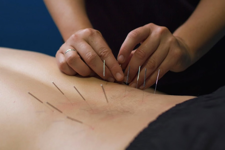 Dry Needling Treatment