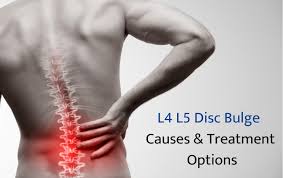 L4-L5 Disc Clinical Diagram